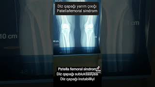 Diz qapağı yarım çıxığı patella femoral sindrom troxlear displaziya [upl. by Cindra]