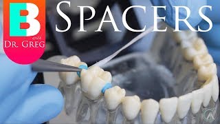 BRACES EXPLAINED Spacers [upl. by Drofub]