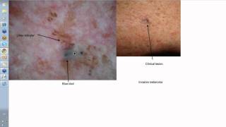 Dermoscopy Made Simple  Melanoma [upl. by Woodring]