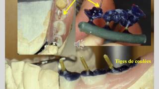 Surfaces Occlusales en prothèse adjointe [upl. by Garrity]