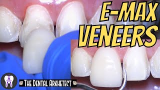 EMAX Porcelain Veneer HOW Do they DO it C41 4k [upl. by Llerehs]