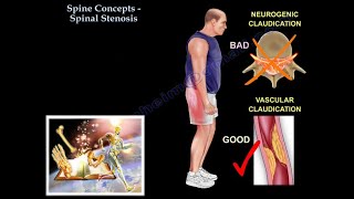 Spinal Stenosis  Everything You Need To Know  Dr Nabil Ebraheim [upl. by Tiffi604]