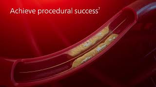 Philips Coronary Laser Atherectomy Catheter  ELCA Mechanism of Action [upl. by Eiliab]