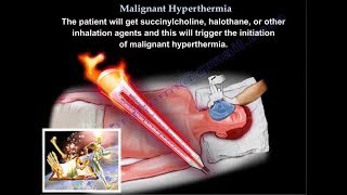 Malignant Hyperthermia  Everything You Need To Know  Dr Nabil Ebraheim [upl. by Aicel]