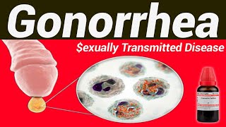 Gonorrhea homeopathic treatment [upl. by Aserat]