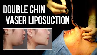 Submental Chin VASER Liposuction Under Local Anesthesia  Dr Wang  West End Plastic Surgery [upl. by Gregoire]