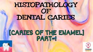 HISTOPATHOLOGY OF DENTAL CARIES  CARIES IN THE ENAMEL PART1 [upl. by Bearnard502]