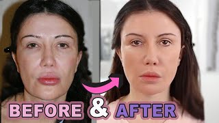 My Face Lift Before and After Part 2 [upl. by Ahsienad]