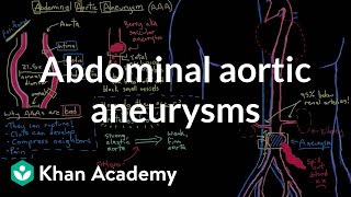 Abdominal aortic aneurysms  Circulatory System and Disease  NCLEXRN  Khan Academy [upl. by Orlanta602]