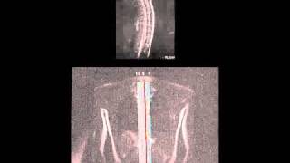 THORACIC SPINE MRI SAGITTAL [upl. by Warfeld]