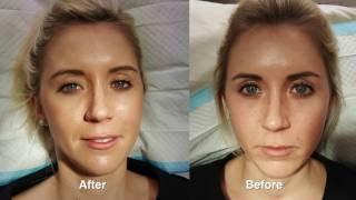 Juvederm rejuvenation w Before amp After Pictures [upl. by Sirrad]