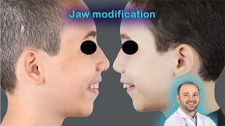 The importance of early correction of the jaw for kidsorthopedic ￼correction of the jawsno surgery [upl. by Leonora]