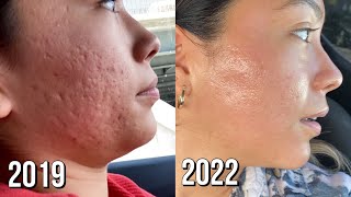 Microneedling Session 8 Before  After [upl. by Killian663]