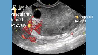 Torsion ovary sonography ultrasound and color Doppler video [upl. by Aihsit]