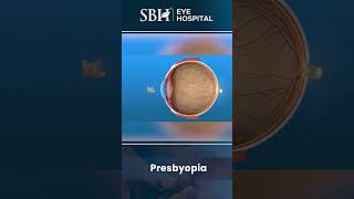 Presbyopia  What is presbyopia  SBH Hospital  Chhattisgarh [upl. by Worsham628]