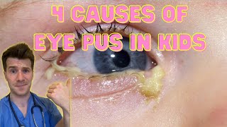 Doctor explains 4 causes of eye pus discharge or sticky eyes in kids  Doctor ODonovan [upl. by Adolphus]