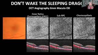 Mastering OCT Interpretation Through Case Analysis [upl. by Forester]