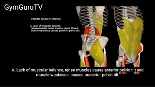 Possible causes of lordosis A lordotic position may be caused by a number of factors [upl. by Ximenez]