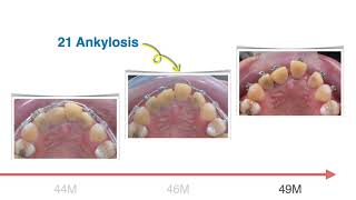 Case Report｜【Chris Chang Ortho】CC607 [upl. by Eirrek748]