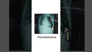 Pneumothorax empyema  water seal chest drainage system  youtubeshortspediatriciansshorts [upl. by Vareck]