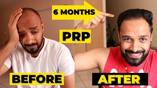 ✅ PRP 6 MONTH RESULTS  3 PRP sessions  HAIR TRANSPLANT vs PRP which one should you really go for [upl. by Cherilyn758]