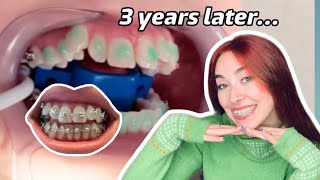 Braces UPDATE no extractions [upl. by Ashlen]