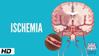 Ischemia Causes Signs and Symptoms Diagnosis and Treatment [upl. by Nimajeb]