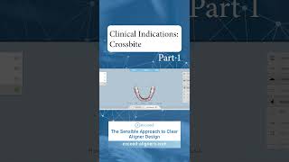 Clinical Indications Crossbite Part 1 [upl. by Candless]