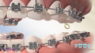 Posterior Crossbite Elastics [upl. by Gavriella]