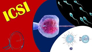 ICSI  Intracytoplasmic Sperm Injection [upl. by Notfilc]