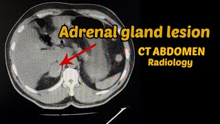 Adrenal gland lesion  CT Abdomen  Radiology [upl. by Kcirdot50]