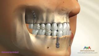 Orthodontic Treatment for Underbite or Crossbite  Bone Anchored Maxillary Protraction [upl. by Mitch45]