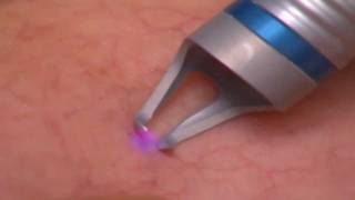 Laser Spider Vein Treatment at JVAI [upl. by Akeyla982]