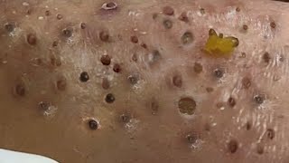 LARGE Blackheads Removal  Satisfying Blackhead 2019 Part 06 [upl. by Dloreg]