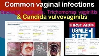 Common vaginal infections Bacterial vaginosis Trichomanas vaginitis amp Candida vulvovaginitis [upl. by Trina]