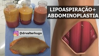 ABDOMINOPLASTIA  LIPOASPIRAÇÃO Cirurgia Abdomen  Dr Valter [upl. by Yffat886]