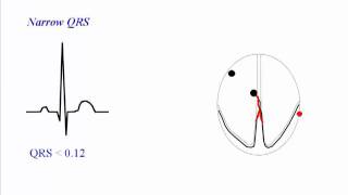 ECG QRS Complex [upl. by Dnalerb]