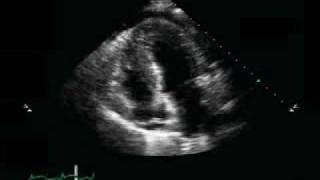 Pericardial Effusion Pulmonary Edema [upl. by Kimberley]