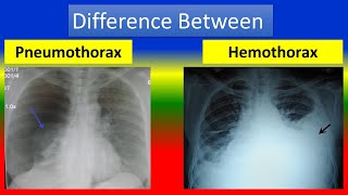 Difference between Pneumothorax and Hemothorax [upl. by Rhodes]