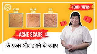 The Most Effective Acne Scars Treatment  Acne Scar Removal  Types of Acne Scars  Dr Nivedita Dadu [upl. by Norahs]