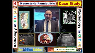 Mesenteric panniculitis  Radiology in GIT 4 [upl. by Spark]