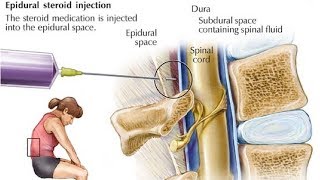 Epidural Steroid Injection Side Effects  Side Effects Of Epidural Injections [upl. by Jo-Anne]