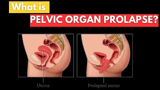 Pelvic Organ Prolapse What You Need to Know [upl. by Benzel]