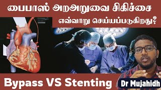 Stenting vs Bypass surgery in tamil  Bypass surgery எவ்வாறு செய்யப்படுகிறது Dr Mujahidh [upl. by Chariot]