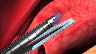 Animation Endo GIA™ Reinforced Reload with Tri Staple™ Technology Chapter 3 orSo6xtt1DI [upl. by Wesle]