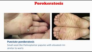 Porokeratosis [upl. by Balcke]