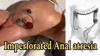 Imperforated Anal atresia Surgery of 1 day old male baby from Nepal medical College at RAS Medcity [upl. by Hoeg993]