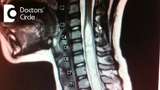 How to manage Syringomyelia in 45 year old  Dr Mohan M R [upl. by Ahsieki]