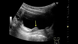 POST TRANSURETHRAL INJECTION USING DEFLUX [upl. by Nahpos]