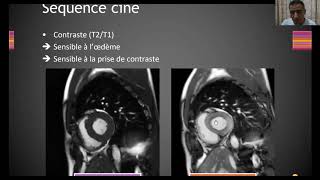 IRM cardiaque  Cardiopathie ischémique [upl. by Enillebyam]